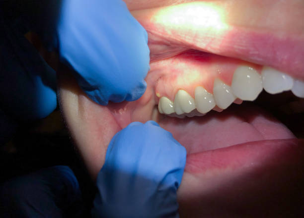 Best Emergency Denture Repair in Colonial Pine Hills, SD