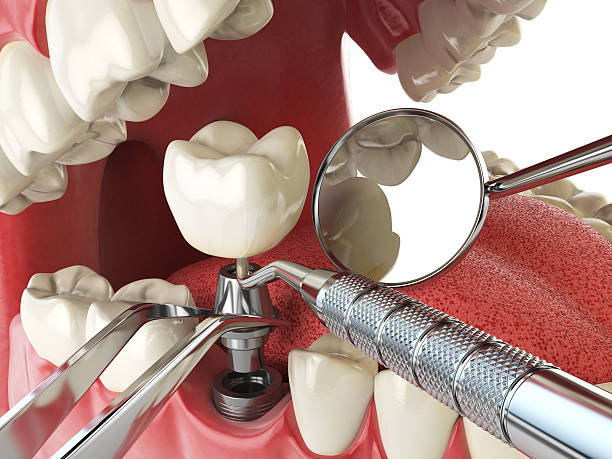 Best Broken or Chipped Tooth Repair in Colonial Pine Hills, SD
